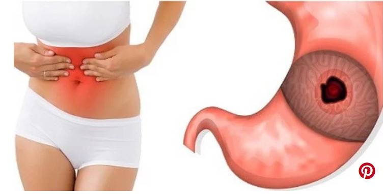 هذه الأشياء تتسبب في إصابتك بقرحة المعدة... ابتعدوا عنها!