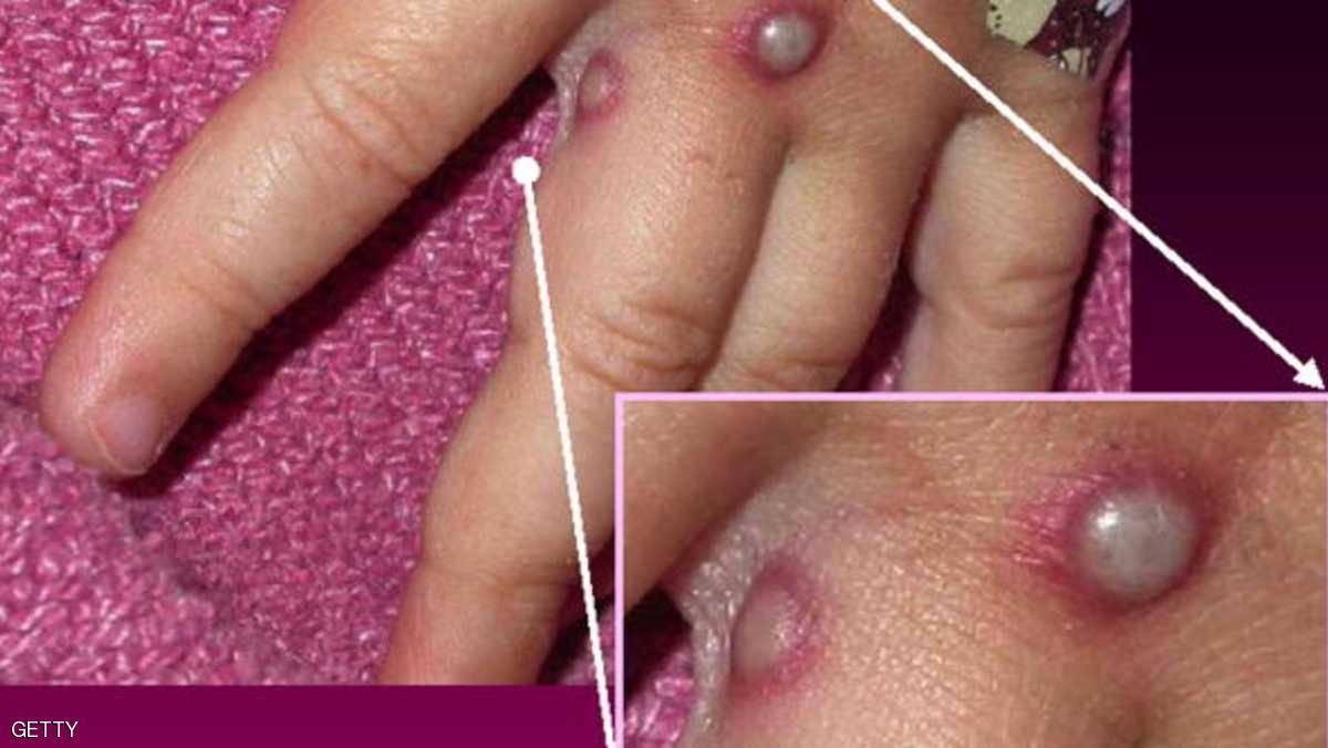 فيروس قاتل يهدد العالم... وباحثون يسابقون الزمن بحثا عن لقاح