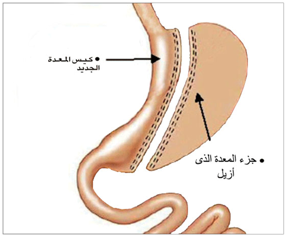 احذروا عمليات قص المعدة لهذه الأسباب!