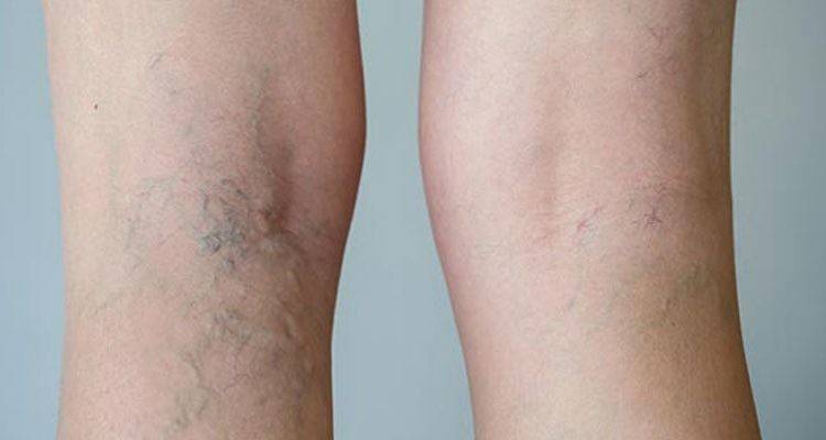 علاج طبيعي للقضاء على دوالي الساقين.. مكوناته في مطبخك!