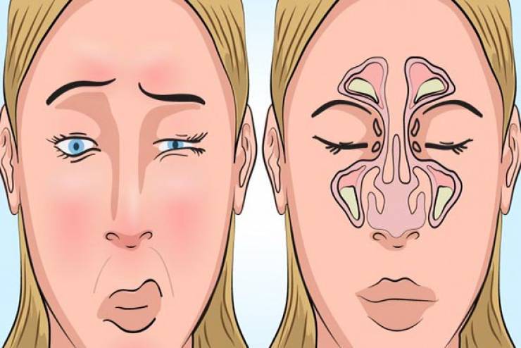 كيف نفتح الجيوب الأنفية و نعالجها بواسطة أصابعنا فقط!
