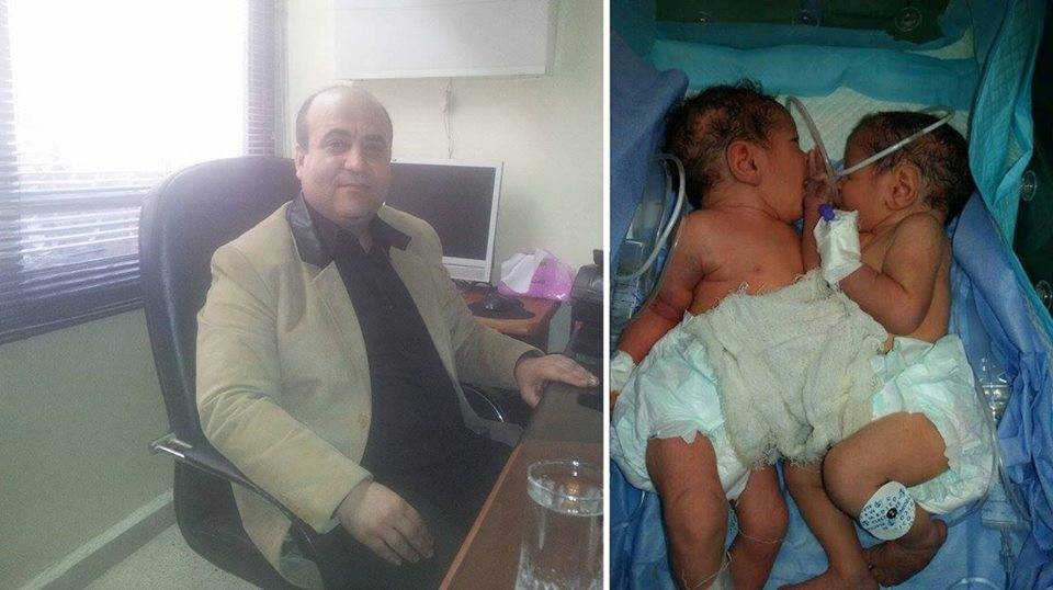 جرّاح سوري يجري أول عملية فصل توأم ملتصق بمشفى تشرين.. ما كانت النتيجة؟