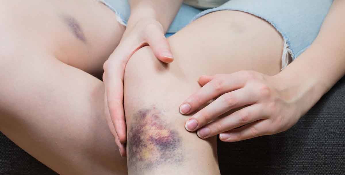 متى عليكم القلق من ظهور الكدمات على جسمكم؟
