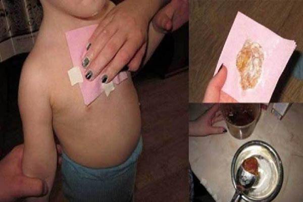 ضمادة الزنجبيل: تزيل البلغم من الرئتين في ليلة واحدة وتعالج السعال الكريه