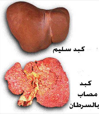 المالتون آخر إختراع لضرب السرطان