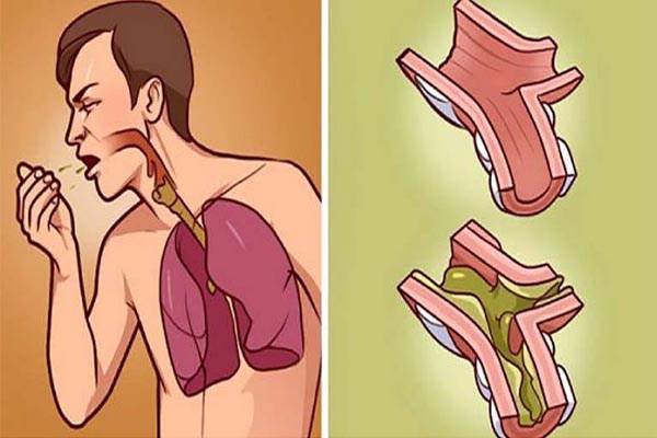 عندما تمتلئ رئتيك بالبلغم هذا أفضل علاج