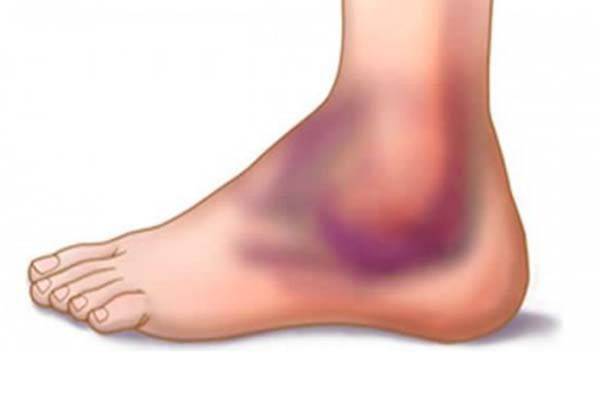 طريقة بسيطة وسريعة لشفاء التواء الكاحل