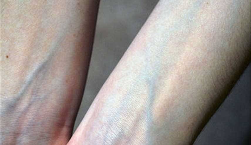 لماذا يظهر الدم بلون أزرق على الجلد رغم أنه في الحقيقة أحمر؟