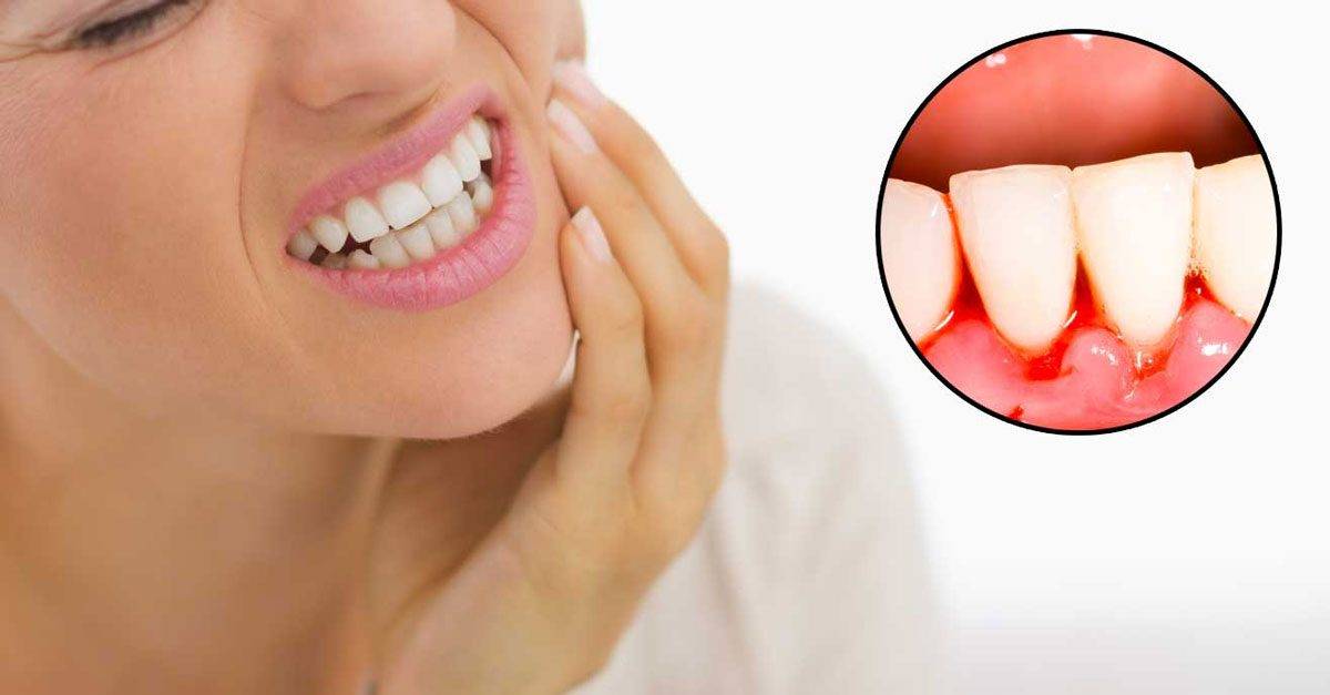 لا تستهينوا بنزيف اللثة.. قد يدل على مشاكل صحية خطيرة!