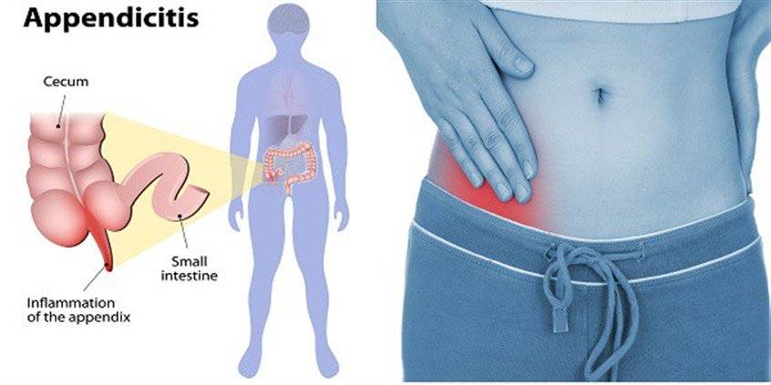 إلتهاب الزّائدة الدوديّة appendicitis : الأعراض والعلامات وأهمّيّة التدخّل المبكّر