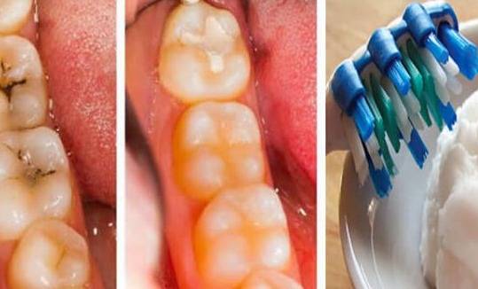 لأسنان بيضاء وخالية من التسوّس.. استبدلوا معجون الأسنان بهذا الخليط الطبيعي