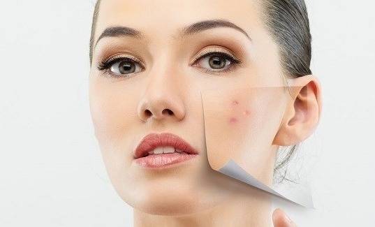 طرق لمحاربة البثور الهرمونية