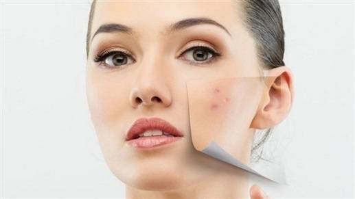 4 حلول لمحاربة البثور الهرمونيّة