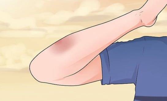 تعرفوا إلى أسباب ظهور الكدمات على أجسامكم