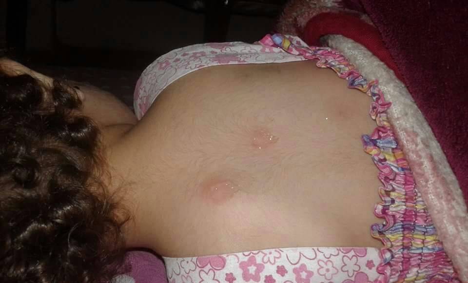 البرغش السّام يغزو طرابلس.. والأطفال هم الضحية!