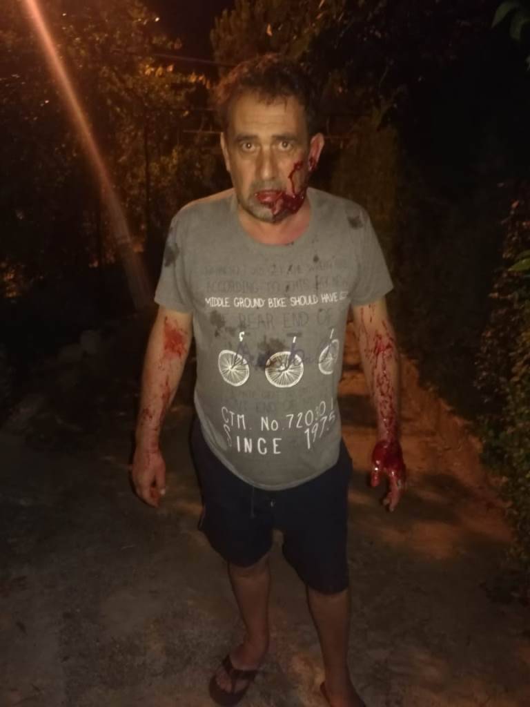 بالصورة..اصابة 3 اشخاص هاجمهما كلبان شرسان في تبنيت