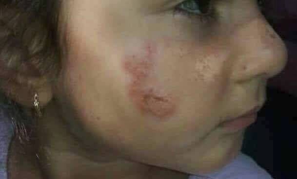 بالصورة.. إصابة جديدة: احذروا النزول الى البحر والسباحة!