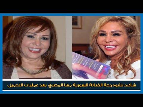 بعد تشوهها من عمليات التجميل.. مها المصري تستعيد ملامحها من جديد