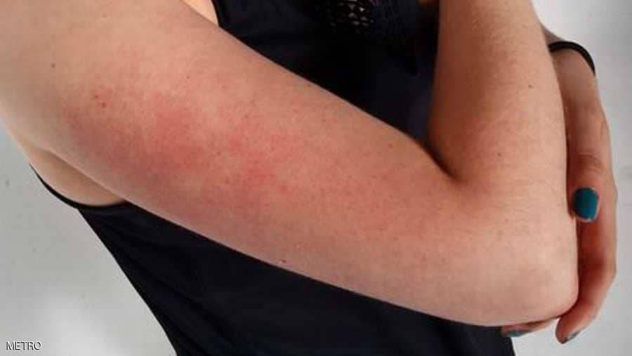 معضلة جلد الدجاج.. أسبابها وكيفية علاجها