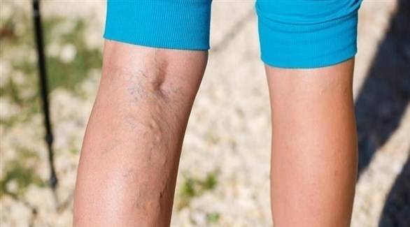 ما هي أسباب ظهور دوالي الساقين؟