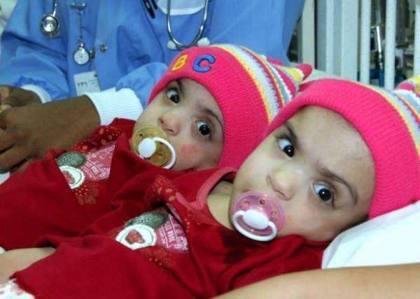 بعد مرور 11 سنة على عملية فصلهما عن بعضهما..هكذا أصبح التوام