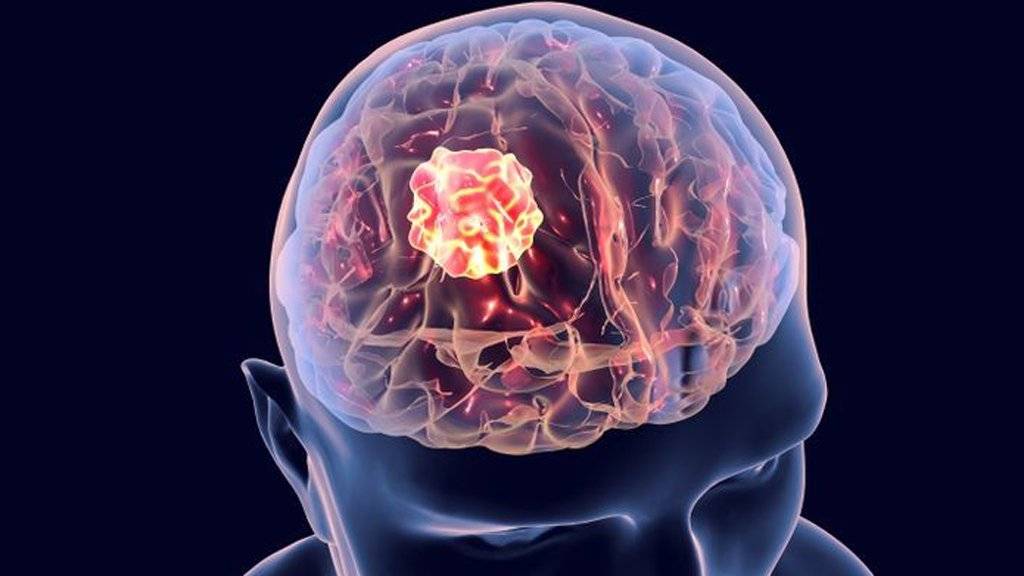 فريق علمي مصري يبتكر استراتيجية لعلاج سرطان الدماغ