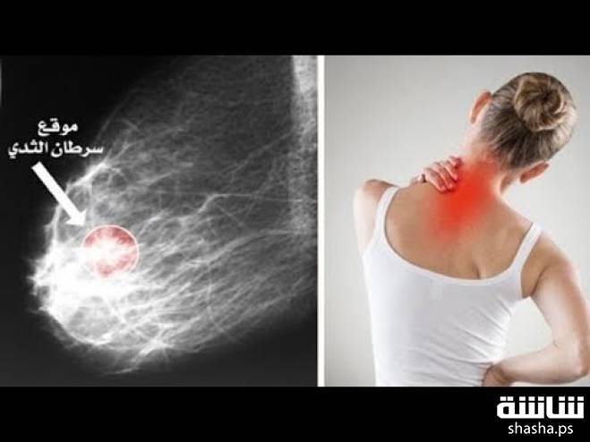 لا تتجاهلوها… أولى أعراض مرض السرطان