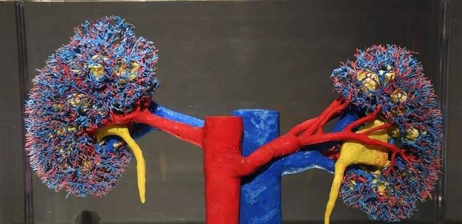 هذه هي الأسباب لتكون حصى الكلى