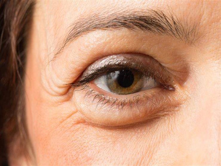 هل تعانين من انتفاخ العينين؟ عالجي المشكلة بهذه الطرق الطبيعية