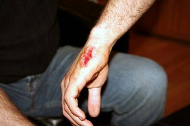ابتكار رغوة خاصة لغلق جروح الأعيرة النارية