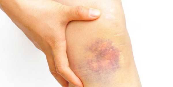ما علاقة الكدمات بأعراض مرض الكبد؟