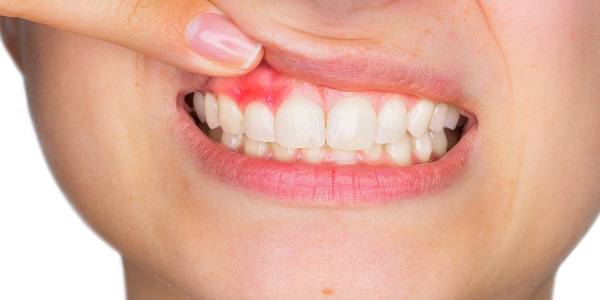 هذه الأعراض تدل على وجود خراج بالأسنان
