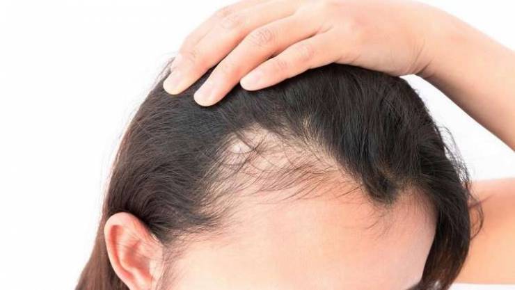6 بدائل طبيعية لمحاربة تساقط الشعر