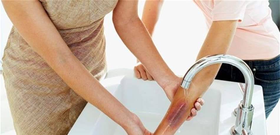 هام جداً.. هذه هي الخطوات الصحيحة للتعامل مع الحروق