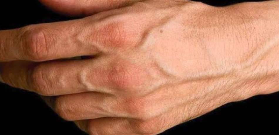 بروز العروق في الجسم.. متى تستدعي استشارة الطبيب؟
