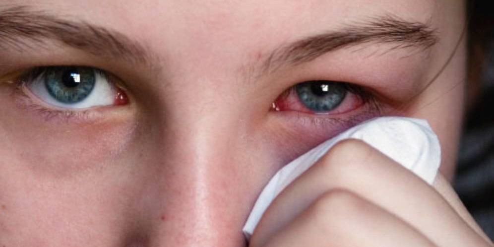 ما لا تعرفه عن حساسية العين.. أعراضها وطرق علاجها