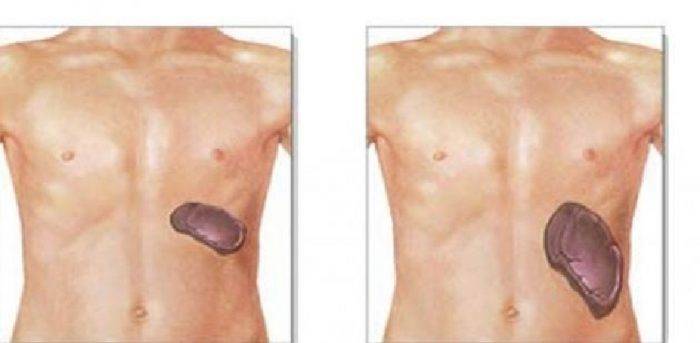أهم أعراض تضخم الطحال والأسباب المؤدية له مع طريق العلاج