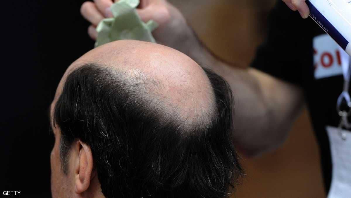 8 أسباب "غير مألوفة" لتساقط الشعر