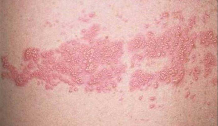 طرق علاج الحزام الناري وأهم أسبابه وأعراضه