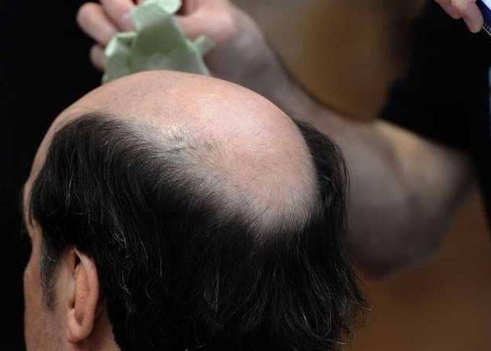 8 أسباب "غير مألوفة" لتساقط الشعر