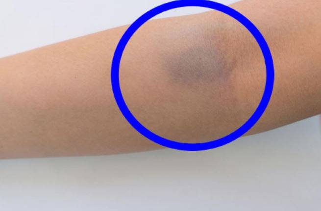 أسباب ظهور بقع زرقاء في الجسم