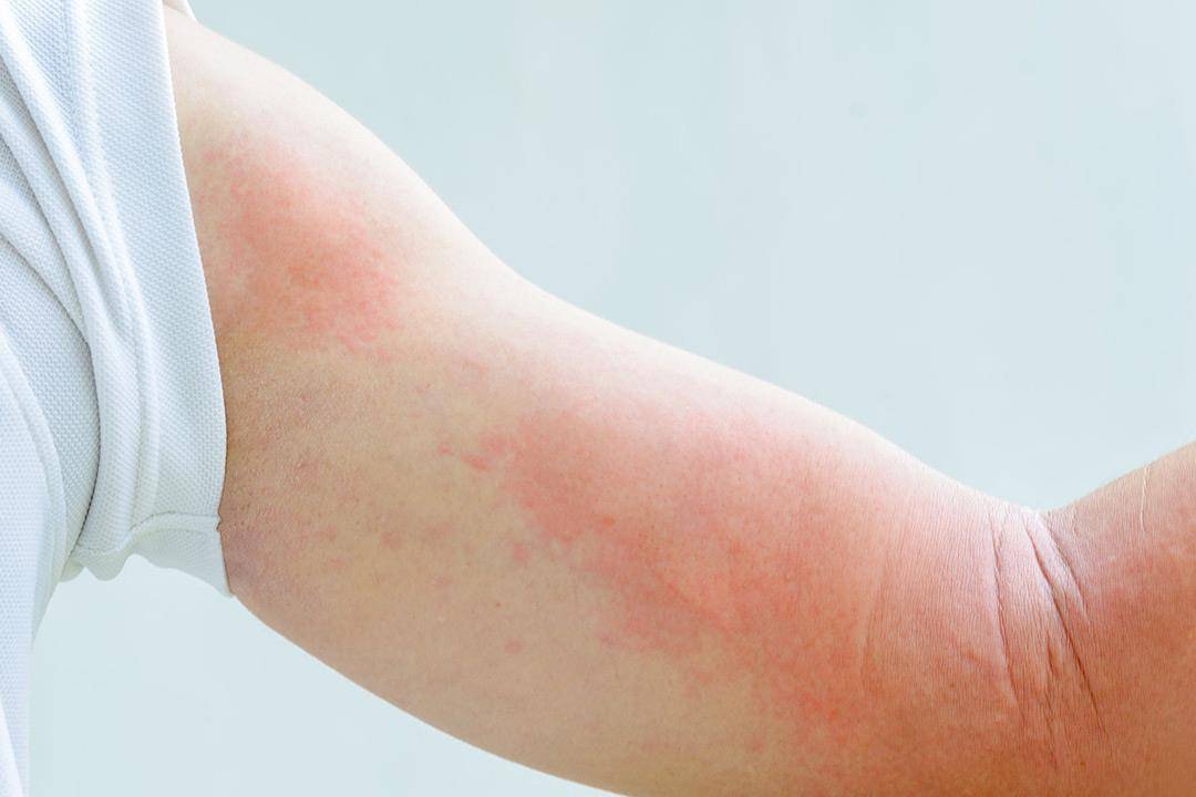 أسباب متعددة للارتكاريا المزمنة.. هل تسبب الوفاة؟