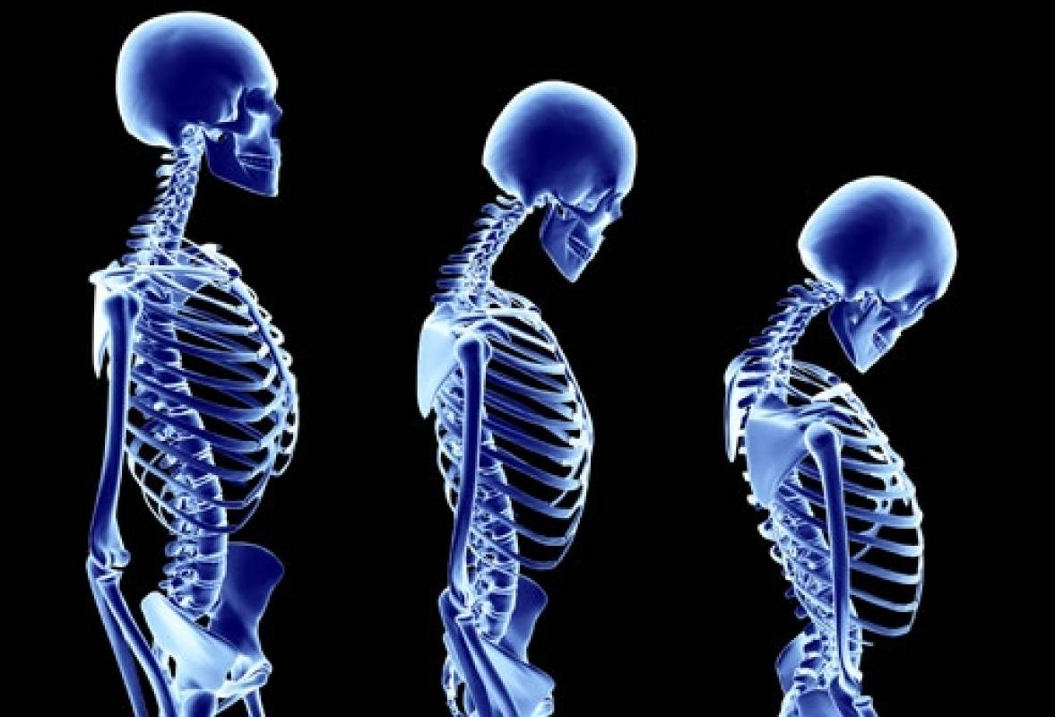 أدوية تساعدكم على مكافحة مرض هشاشة العظام