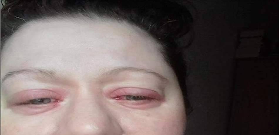 حالة صحية نادرة.. تذرف الدماء من عينيها وجلدها يتساقط!