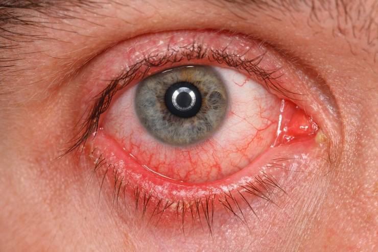 ماذا تخبرك عينك عن صحتك ؟