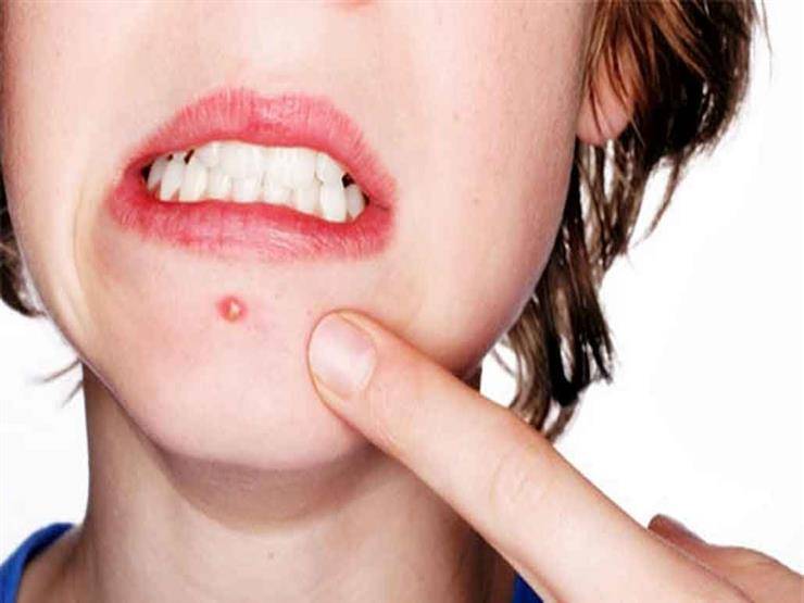 بأحدث التقنيات.. علاج حب الشباب باستخدام "غبار الذهب"