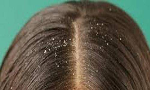 تعرفوا الى أسباب القشرة وكيف تتخلصون منها