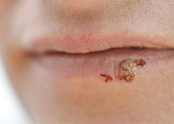 ما علاقة السرطان بفيروس الهربس؟