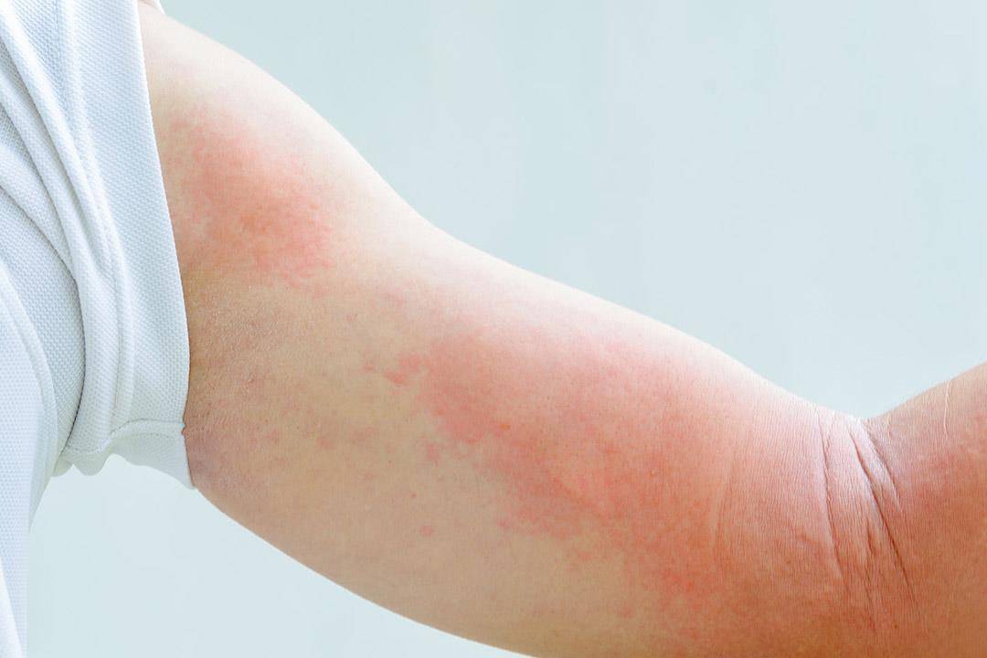 الارتكاريا.. أسبابها وأنواعها وكيفية العلاج