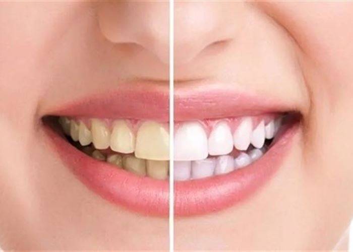 أخطاء تسبب صفرة أسنانك